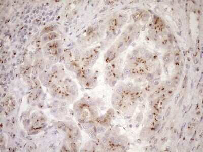 Immunohistochemistry: TRIM56 Antibody (5A1) [NBP2-46232] - Analysis of Carcinoma of Human liver tissue.(Heat-induced epitope retrieval by 1mM EDTA in 10mM Tris buffer (pH8.5) at 120C for 3 min)