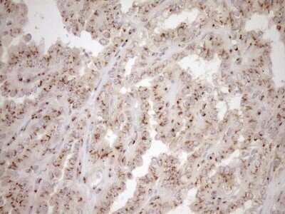 Immunohistochemistry: TRIM56 Antibody (5A1) [NBP2-46232] - Analysis of Carcinoma of Human thyroid tissue. (Heat-induced epitope retrieval by 1mM EDTA in 10mM Tris buffer (pH8.5) at 120C for 3 min)