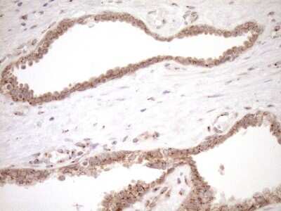 Immunohistochemistry: TRIM56 Antibody (5A1) [NBP2-46232] - Analysis of Carcinoma of Human prostate tissue. (Heat-induced epitope retrieval by 1mM EDTA in 10mM Tris buffer (pH8.5) at 120C for 3 min)