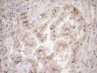 Immunohistochemistry: TRIM56 Antibody (OTI5A1) - Azide and BSA Free [NBP2-74613] - Analysis of Carcinoma of Human liver tissue.(Heat-induced epitope retrieval by 1mM EDTA in 10mM Tris buffer (pH8.5) at 120C for 3 min)
