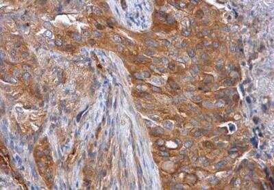Immunohistochemistry-Paraffin: TRIOBP Antibody [NBP2-20726] - Human lung cancer diluted at 1:500