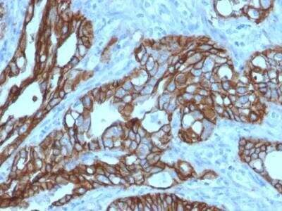 Immunohistochemistry-Paraffin: TROP-2 Antibody (TACSTD2/2152) - Azide and BSA Free [NBP2-75746] - Formalin-fixed, paraffin-embedded human Colon Carcinoma stained with TACSTD2 / TROP2 Mouse Monoclonal Antibody (TACSTD2/2152).