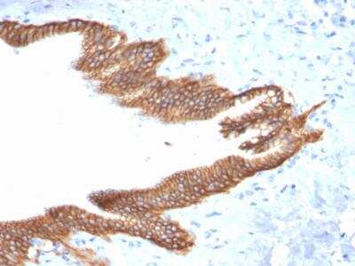 Immunohistochemistry-Paraffin: TROP-2 Antibody (TACSTD2/2152) - Azide and BSA Free [NBP2-75746] - Formalin-fixed, paraffin-embedded human Pancreatic Carcinoma stained with TACSTD2 / TROP2 Mouse Monoclonal Antibody (TACSTD2/2152).