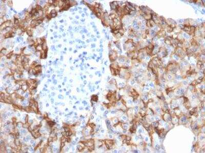 Immunohistochemistry-Paraffin: TROP-2 Antibody (TACSTD2/2152) - Azide and BSA Free [NBP2-75746] - Formalin-fixed, paraffin-embedded human Pancreatic Carcinoma stained with TACSTD2 / TROP2 Mouse Monoclonal Antibody (TACSTD2/2152).