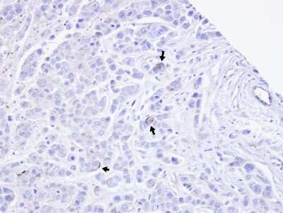 Immunohistochemistry-Paraffin: TRPM2 Antibody [NBP1-33416] - Paraffin-embedded MDAMB468 xenograft, using antibody at 1:100 dilution.