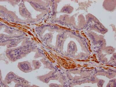 Immunohistochemistry: TRPM8 Antibody (2G7) [NBP3-15183] - IHC image of TRPM8 antibody diluted at 1:100 and staining in paraffin-embedded human prostate cancer. After dewaxing and hydration, antigen retrieval was mediated by high pressure in a citrate buffer (pH 6.0). Section was blocked with 10% normal goat serum 30 minutes at RT. Then primary antibody (1% BSA) was incubated at 4C overnight. The primary is detected by a Goat anti-rabbit IgG polymer labeled by HRP and visualized using 0.05% DAB.
