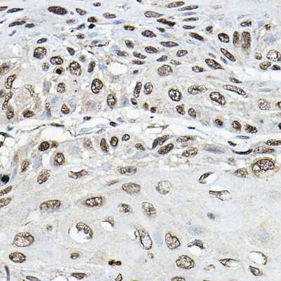 Immunohistochemistry-Paraffin: TRRAP Antibody [NBP3-15607] - Immunohistochemistry of paraffin-embedded human esophageal cancer using TRRAP Rabbit pAb (NBP3-15607) at dilution of 1:100 (40x lens).Perform microwave antigen retrieval with 10 mM PBS buffer pH 7.2 before commencing with IHC staining protocol.