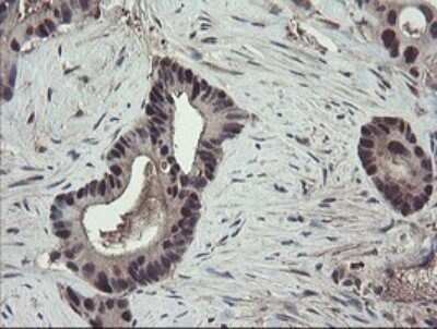 Immunohistochemistry: TSC22/TSC22D1 Antibody (OTI4H8) - Azide and BSA Free [NBP2-74654] - Analysis of Adenocarcinoma of Human colon tissue.