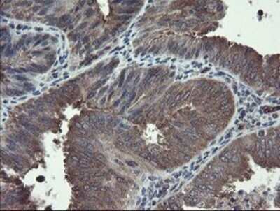 Immunohistochemistry: TSC22/TSC22D1 Antibody (OTI4H8) - Azide and BSA Free [NBP2-74654] - Analysis of Adenocarcinoma of Human endometrium tissue.