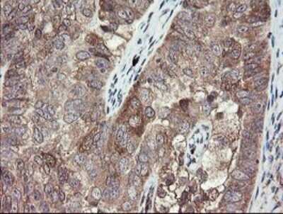 Immunohistochemistry: TSC22/TSC22D1 Antibody (OTI4H8) - Azide and BSA Free [NBP2-74654] - Analysis of Adenocarcinoma of Human ovary tissue.