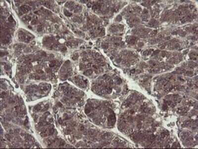 Immunohistochemistry: TSC22/TSC22D1 Antibody (OTI4H8) - Azide and BSA Free [NBP2-74654] - Analysis of Carcinoma of Human liver.