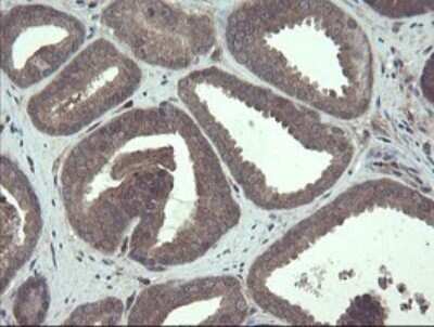 Immunohistochemistry: TSC22/TSC22D1 Antibody (OTI4H8) - Azide and BSA Free [NBP2-74654] - Analysis of Carcinoma of Human prostate tissue.