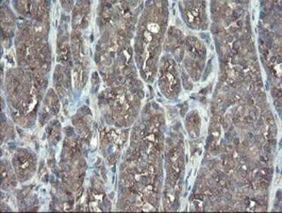 Immunohistochemistry: TSC22/TSC22D1 Antibody (OTI4H8) - Azide and BSA Free [NBP2-74654] - Analysis of Carcinoma of Human thyroid tissue.