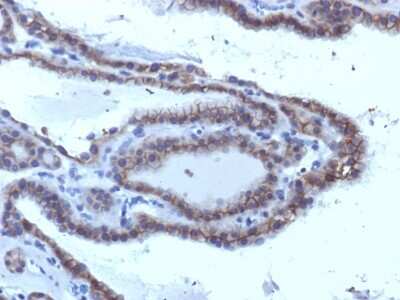 Immunohistochemistry-Paraffin: TSH R Antibody (SPM223) [NBP2-54569] - Formalin-fixed, paraffin-embedded human Thyroid Carcinoma stained with TSHRA Monoclonal Antibody (SPM223).