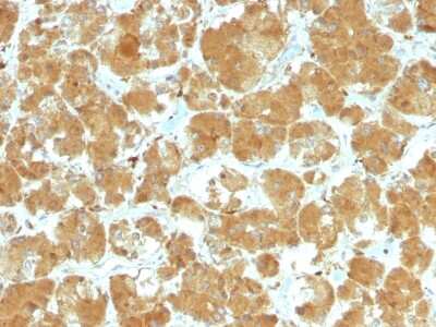 Immunohistochemistry-Paraffin: TSH R Antibody (TSHRA/1402) [NBP2-54343] - Formalin-fixed, paraffin-embedded human Thyroid Carcinoma stained with TSH Receptor, A-Chain MAb (TSHRA/1402).