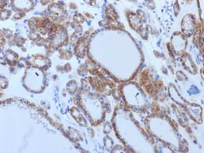 Immunohistochemistry-Paraffin: TSH R Antibody (TSHRB/1405) [NBP2-54322] - Formalin-fixed, paraffin-embedded human Thyroid Carcinoma stained with TSHRB Monoclonal Antibody (TSHRB/1405).