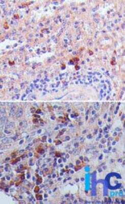 Immunohistochemistry-Paraffin: TSLP Antibody (55N1D10) [NBP2-27326] - FFPE normal human spleen (top) and human lung carcinoma (bottom) stained with TSLP antibody, peroxidase-conjugate and DAB chromogen.