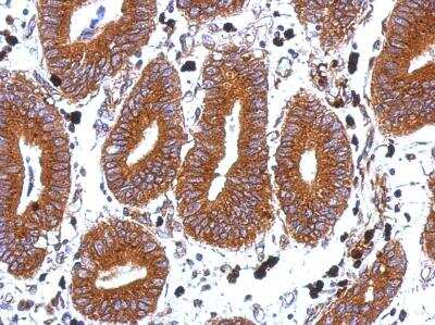 Immunohistochemistry-Paraffin: TSPAN1 Antibody [NBP1-30931] - Paraffin-embedded Colon ca, using antibody at 1:500 dilution.