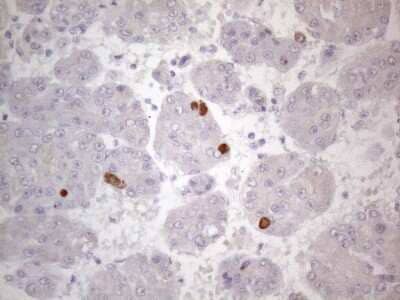 Immunohistochemistry: TTC14 Antibody (9E11) [NBP2-46239] - Analysis of Carcinoma of Human liver tissue.(Heat-induced epitope retrieval by 1mM EDTA in 10mM Tris buffer (pH8.5) at 120C for 3 min)