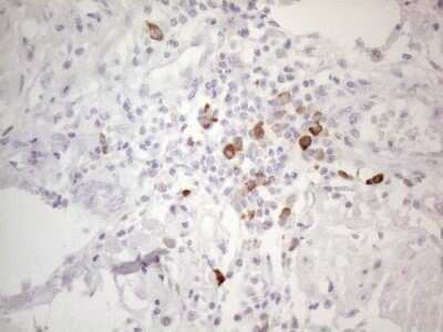 Immunohistochemistry: TTC14 Antibody (OTI9E11) - Azide and BSA Free [NBP2-74655] - Analysis of Adenocarcinoma of Human colon tissue. (Heat-induced epitope retrieval by 1mM EDTA in 10mM Tris buffer (pH8.5) at 120C for 3 min)