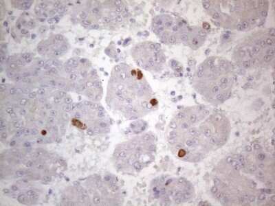Immunohistochemistry: TTC14 Antibody (OTI9E11) - Azide and BSA Free [NBP2-74655] - Analysis of Carcinoma of Human liver tissue.(Heat-induced epitope retrieval by 1mM EDTA in 10mM Tris buffer (pH8.5) at 120C for 3 min)