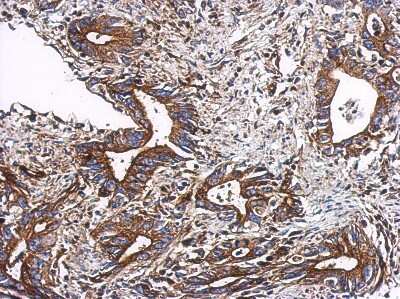 Immunohistochemistry-Paraffin: TTC31 Antibody [NBP2-20754] - Immunohistochemical analysis of paraffin-embedded Colon ca, using antibody at 1:500 dilution.