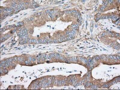 Immunohistochemistry: TTC32 Antibody (OTI1F7) - Azide and BSA Free [NBP2-74656] - Staining of paraffin-embedded Adenocarcinoma of Human colon tissue using anti-TTC32 mouse monoclonal antibody.