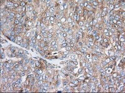 Immunohistochemistry: TTC32 Antibody (OTI1F7) - Azide and BSA Free [NBP2-74656] - Staining of paraffin-embedded Adenocarcinoma of Human ovary tissue using anti-TTC32 mouse monoclonal antibody.