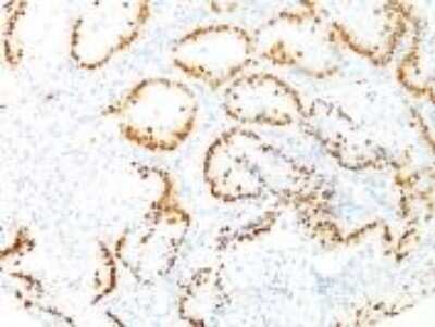 Immunohistochemistry-Paraffin: TTF-1 / NKX2-1 Antibody (8G7G3/1) - Azide and BSA Free [NBP2-34544] - Formalin-fixed, paraffin-embedded human Lung Adenocarcinoma stained with TTF-1 Monoclonal Antibody (8G7G3/1)