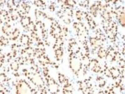 Immunohistochemistry-Paraffin: TTF-1 / NKX2-1 Antibody (8G7G3/1) - Azide and BSA Free [NBP2-34544] - Formalin-fixed, paraffin-embedded human Thyroid stained with TTF-1 Monoclonal Antibody (8G7G3/1)