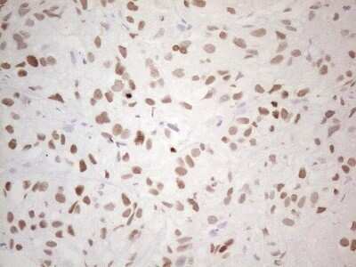 Immunohistochemistry: TTF-1 / NKX2-1 Antibody (OTI10F8) - Azide and BSA Free [NBP2-74667] - Analysis of Carcinoma of Human lung tissue.(Heat-induced epitope retrieval by 1mM EDTA in 10mM Tris buffer (pH8.5) at 120C for 3 min)