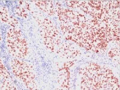 Immunohistochemistry-Paraffin: TTF-1 / NKX2-1 Antibody (SPM150) - IHC-Prediluted [NBP2-44499] - Human LUng Carcinoma