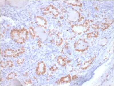 Immunohistochemistry-Paraffin: TTF-1 / NKX2-1 Antibody (rNX2.1/690) - Azide and BSA Free [NBP3-08725] - Formalin-fixed, paraffin-embedded human Lung Adenocarcinoma stained with TTF-1 / NKX2-1 Mouse Recombinant Monoclonal Antibody (rNX2.1/690).