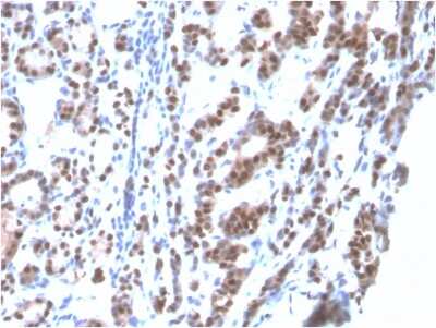 Immunohistochemistry-Paraffin: TTF-1 / NKX2-1 Antibody (rNX2.1/690) - Azide and BSA Free [NBP3-08725] - Formalin-fixed, paraffin-embedded human Thyroid stained with TTF-1 / NKX2-1 Mouse Recombinant Monoclonal Antibody (rNX2.1/690).