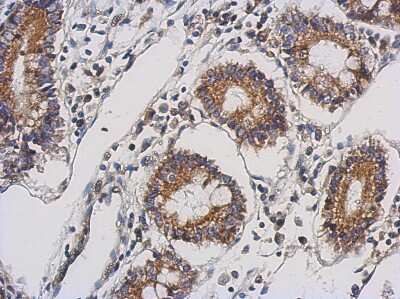 Immunohistochemistry-Paraffin: TTLL10 Antibody [NBP2-20755] - Immunohistochemical analysis of paraffin-embedded Gastric ca, using antibody at 1:500 dilution.