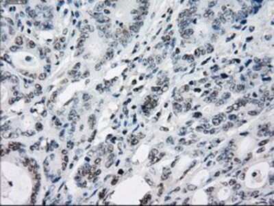 Immunohistochemistry: TTP Antibody (OTI8B5) - Azide and BSA Free [NBP2-74681] - Staining of paraffin-embedded Adenocarcinoma of Human colon tissue using anti-TTP mouse monoclonal antibody.