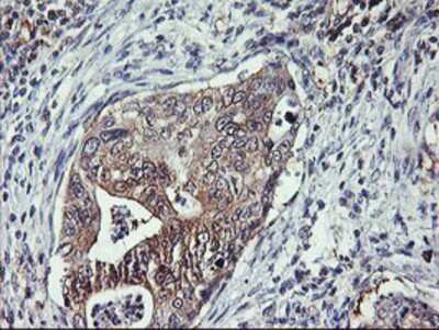 Immunohistochemistry-Paraffin: TULP3 Antibody (7B8) [NBP2-01671] - Staining of paraffin-embedded Carcinoma of Human pancreas tissue using anti-TULP3 mouse monoclonal antibody.