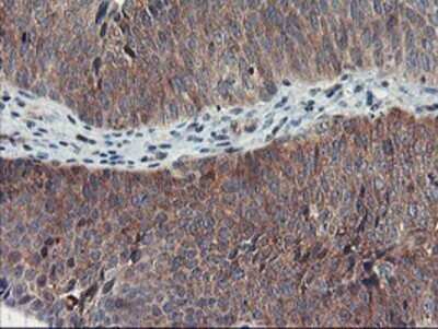 Immunohistochemistry: TULP3 Antibody (OTI7B8) - Azide and BSA Free [NBP2-74721] - Staining of paraffin-embedded Carcinoma of Human bladder tissue using anti-TULP3 mouse monoclonal antibody.