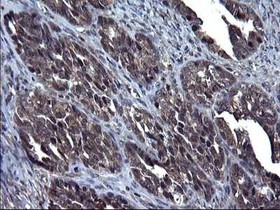 Immunohistochemistry-Paraffin: TXNDC5 Antibody (OTI2E6) [NBP2-46256] - Analysis of Adenocarcinoma of Human ovary tissue. (Heat-induced epitope retrieval by 1 mM EDTA in 10mM Tris, pH8.5, 120C for 3min)