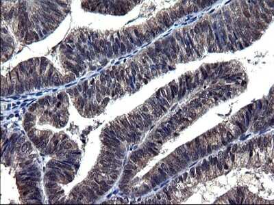 Immunohistochemistry-Paraffin: TXNDC5 Antibody (OTI2E6) [NBP2-46256] - Analysis of Adenocarcinoma of Human endometrium tissue. (Heat-induced epitope retrieval by 1 mM EDTA in 10mM Tris, pH8.5, 120C for 3min)