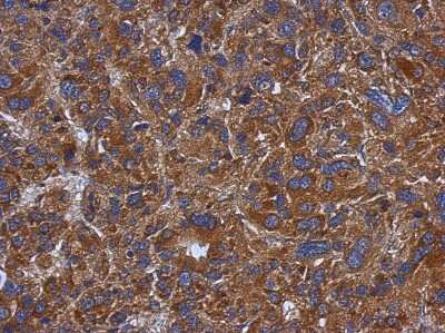 <b>Genetic Strategies Validation. </b>Immunohistochemistry-Paraffin: TXNDC5 Antibody [NBP2-20764] - Immunohistochemical analysis of paraffin-embedded Hepatoma, using antibody at 1:500 dilution.