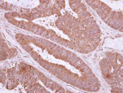 Immunohistochemistry-Paraffin: TXNDC6 Antibody [NBP2-15152] - Paraffin-embedded colon carcinoma, using antibody at 1:500 dilution.