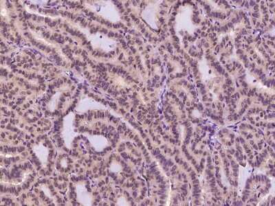 Immunohistochemistry-Paraffin: TXNL1 Antibody [NBP2-99643] - Immunochemical staining TXNL1 in human thyroid carcinoma with rabbit polyclonal antibody at 1:1000 dilution, formalin-fixed paraffin embedded sections.