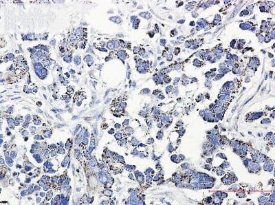 Immunohistochemistry-Paraffin: TXNRD2 Antibody (S02-2D6) [NBP3-19797] - Immunohistochemistry of TXNRD2 in paraffin-embedded Human Cholangiocarcinoma using NBP3-19797 at dilution 1/20