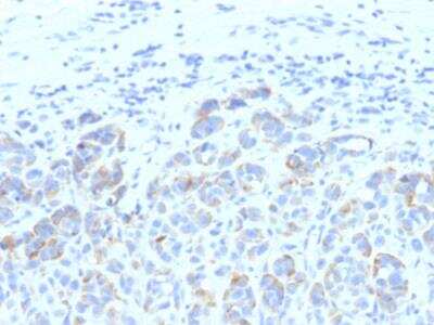 Immunohistochemistry-Paraffin: TYRP1 Antibody (SPM611) - IHC-Prediluted [NBP2-48129] - Human Melanoma stained with TYRP1 monoclonal antibody (SPM611)