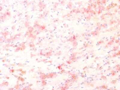 Immunohistochemistry-Paraffin: TYRP1 Antibody (TYRP1/1564R) [NBP2-54446] - Formalin-fixed, paraffin-embedded human Melanoma stained with TYRP1 Recombinant Rabbit Monoclonal Antibody (TYRP1/1564R) using AEC Chromogen (red).