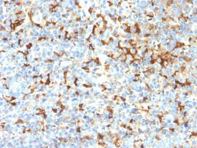 Immunohistochemistry-Paraffin: TYRP1 Antibody (TYRP1/2340R) - Azide and BSA Free [NBP3-08898] - Formalin-fixed, paraffin-embedded human Melanoma stained with TYRP1 Recombinant Rabbit Monoclonal (TYRP1/2340R); DAB Chromogen.