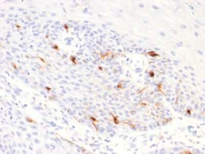 Immunohistochemistry-Paraffin: TYRP1 Antibody (TYRP1/2340R) - Azide and BSA Free [NBP3-08898] - Formalin-fixed, paraffin-embedded human Basal Cell Carcinoma stained with TYRP1 Recombinant Rabbit Monoclonal Antibody (TYRP1/2340R).