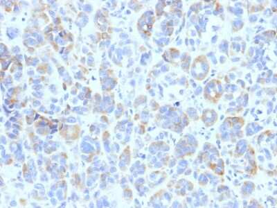 Immunohistochemistry-Paraffin: TYRP1 Antibody (TYRP1/807) [NBP2-54306] - Formalin-fixed, paraffin-embedded human Melanoma stained with TYRP1 Monoclonal Antibody (TYRP1/807)