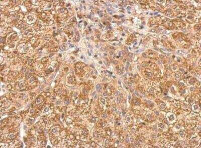 Immunohistochemistry-Paraffin: Tankyrase 1 Antibody [NBP2-20559] - Human hepatoma. Tankyrase antibody dilution: 1:500. Antigen Retrieval: Trilogy™ (EDTA based, pH 8.0) buffer, 15min. 